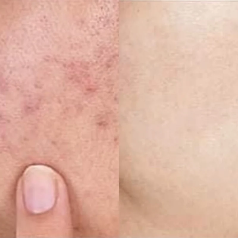 Some By Mi - Mousse nettoyante anti-acné AHA/BHA/PHA - 100ml