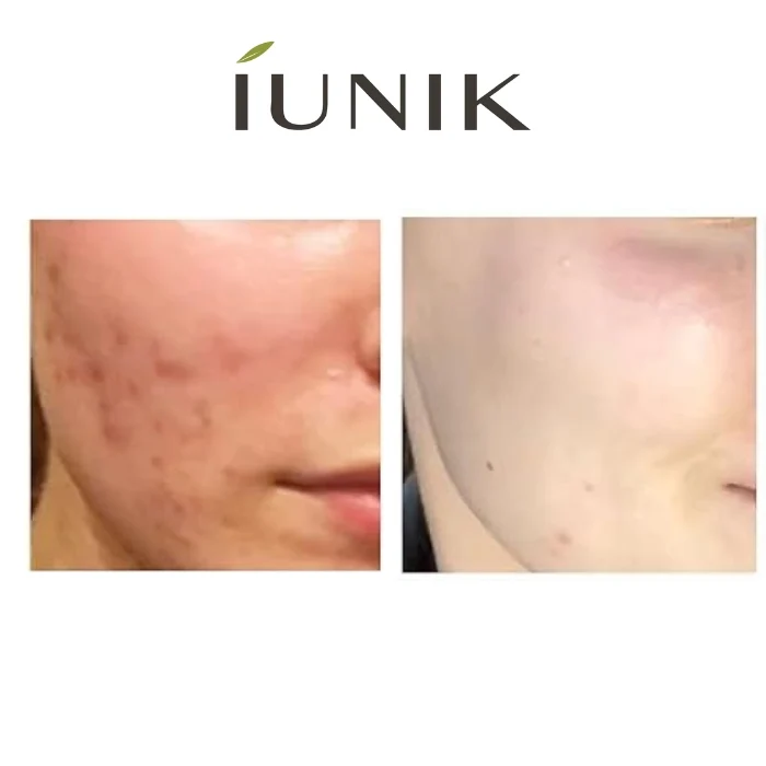 iUNIK - Sérum apaisant à l’arbre de thé - 50ml
