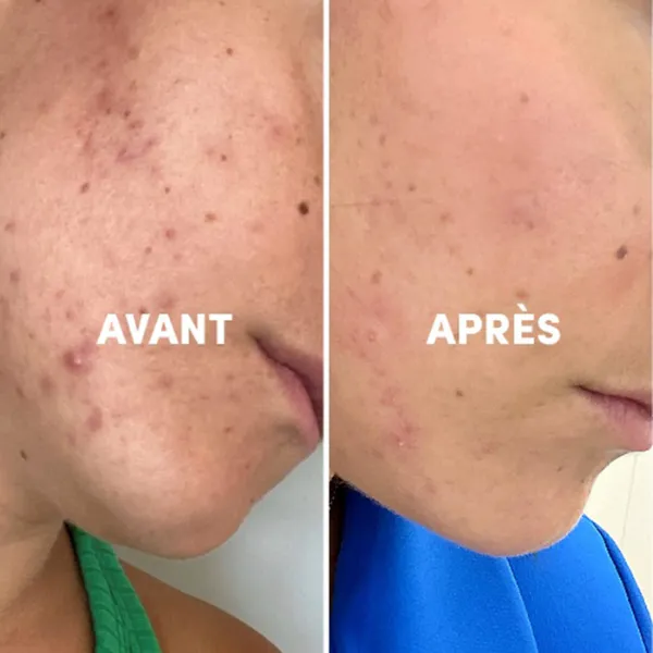 Complexe alimentaire Peau Nette Acnés & Imperfections - WAAM