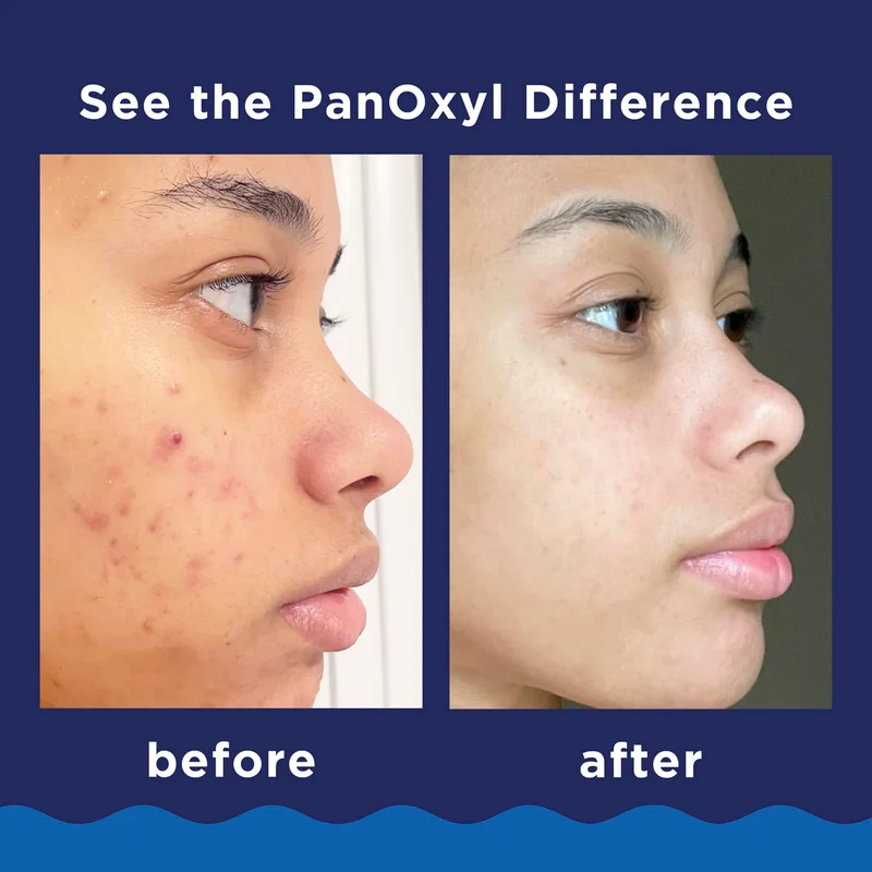 Panoxyl Nettoyant Moussant Contre L'Acné Pour Le Visage Et Le Corps Efficacité Maximale
