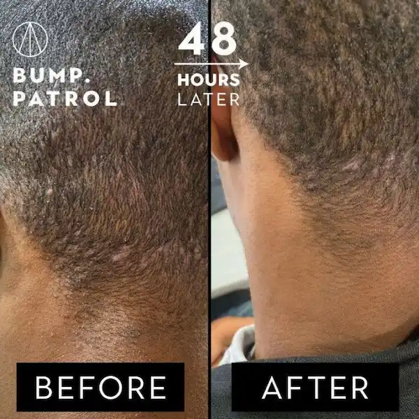 Après-Rasage Aftershave - Bump Patrol