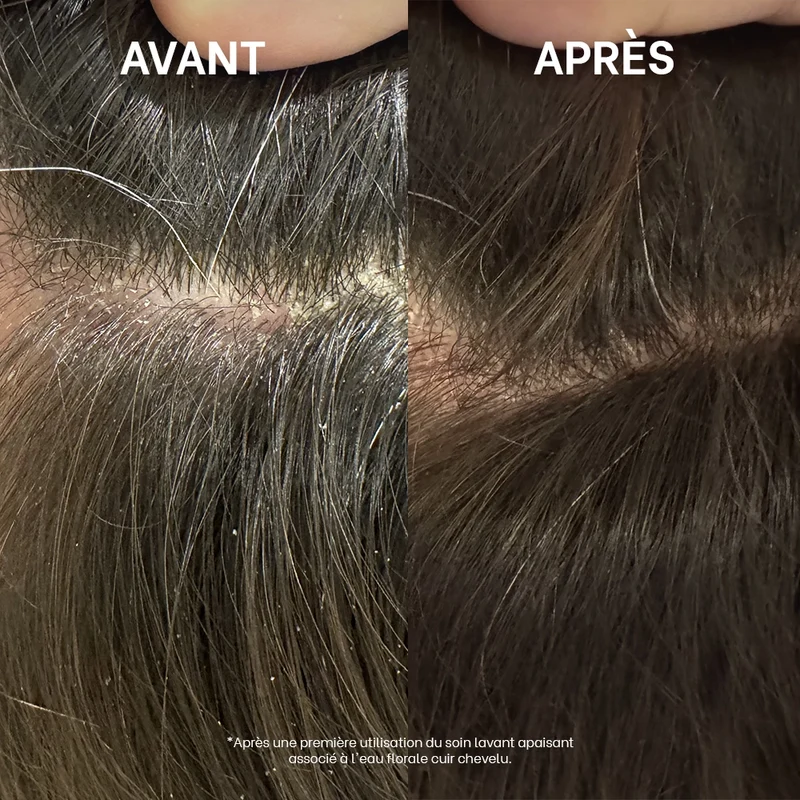 Routine dermite séborrhéique
