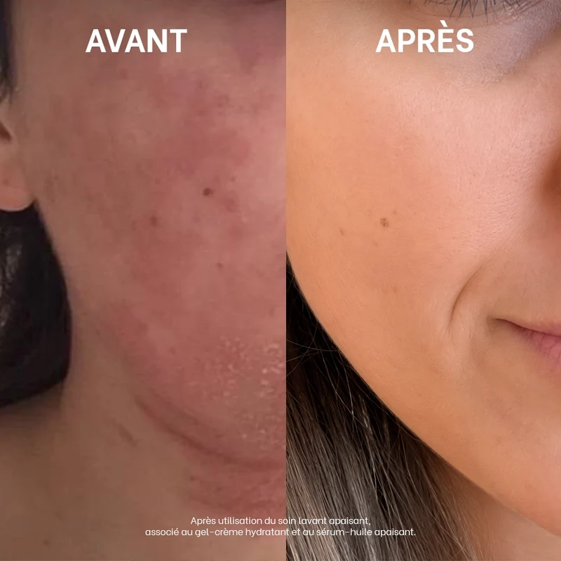 Routine quotidienne eczéma atopique