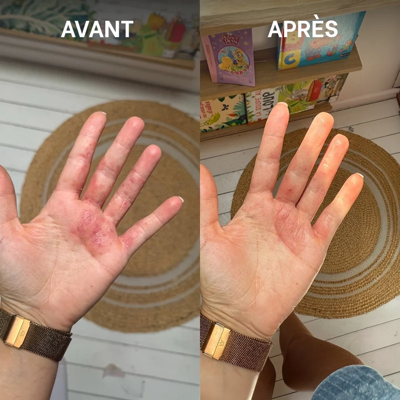 Routine SOS eczéma, psoriasis