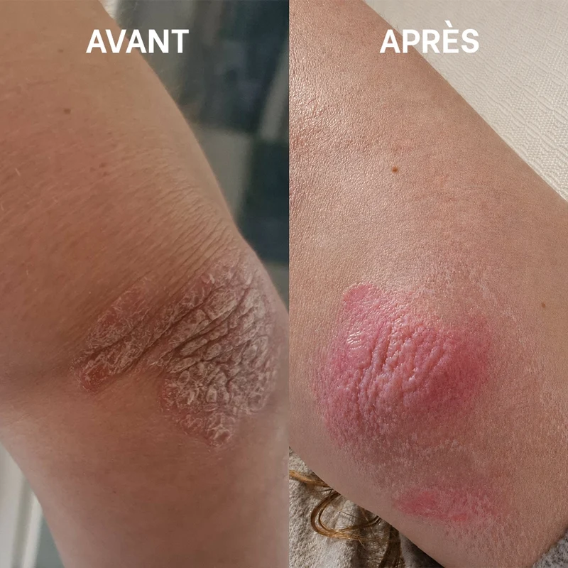 Crème riche SOS sécheresses, squames - 40mL