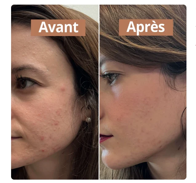 Sérum Anti-Imperfections Comme Avant