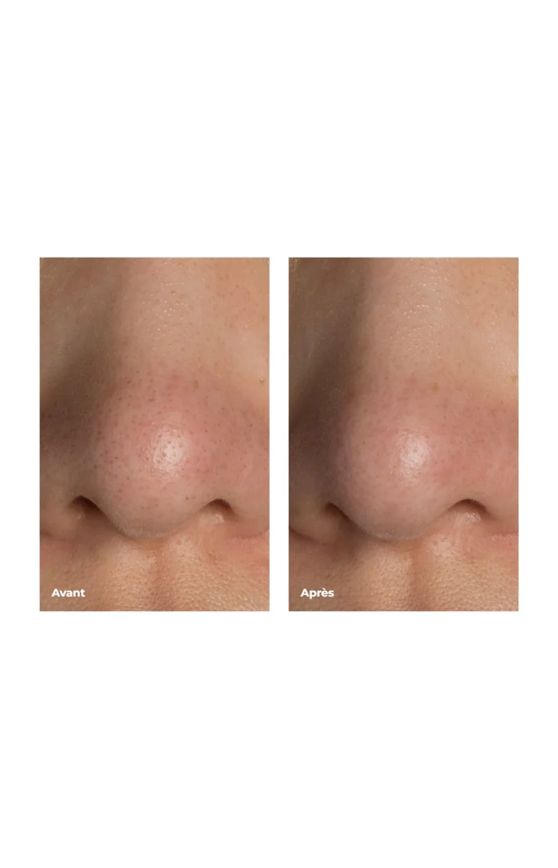 KIWI ™ - Aspirateur points noirs - Visage - Bleu